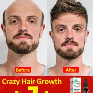 Hair Growth Oil Fast Hair Growth Effective Baldness Repair Hereditary Hair Loss Postpartum Hair Loss Seborrheic Hair Loss
