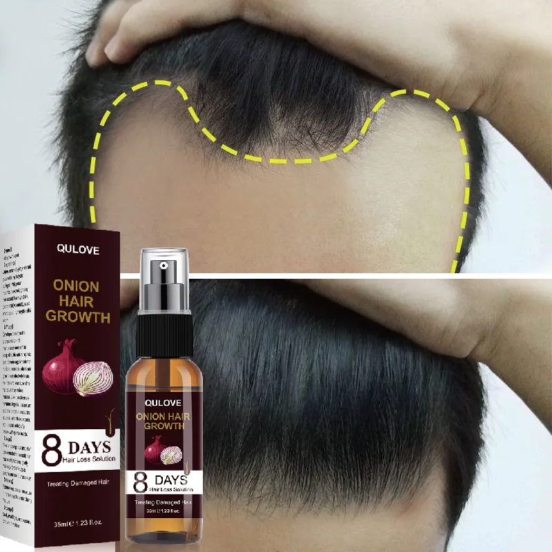 Powerful Hair Growth Serum Onion Spray Anti Hairs Loss Products Treatment Essence Repair Nourish Roots Regrowth For Men Women
